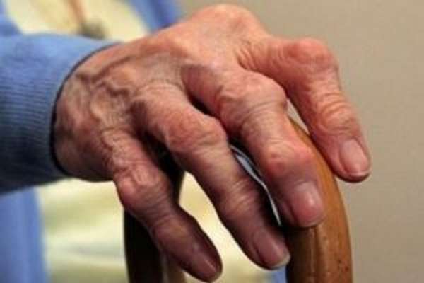 Причины и лечение артрита кистей рук
